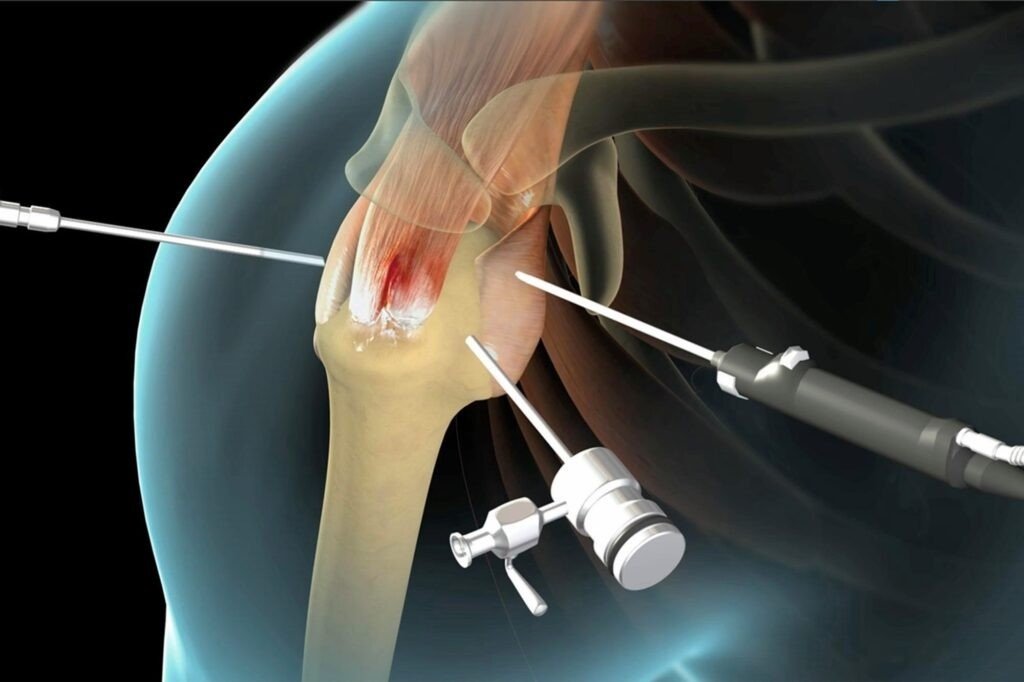 Best Rotator Cuff Injury Treatment in Gurgaon