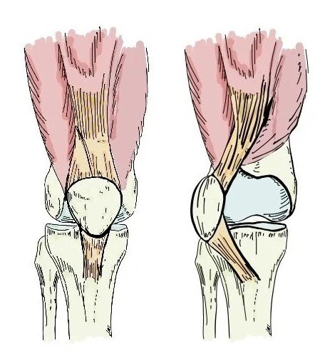 Best Patellar Instability Treatment in Gurugram