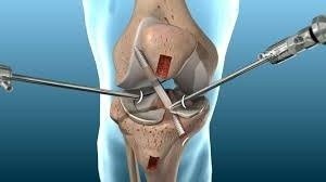 ACL Surgery near Sector 51, Gurugram