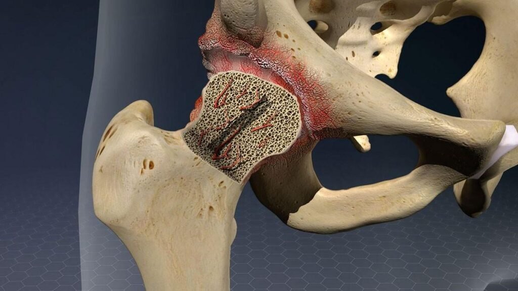 Best Avascular Necrosis Surgeon in Gurugram