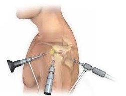 Recurrent Shoulder Dislocation Treatment in Sector 51, Gurugram