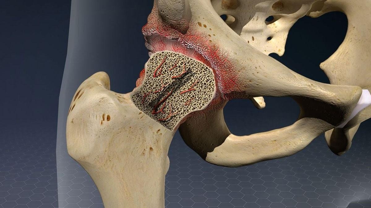 Best Avascular Necrosis Surgeon in Gurugram