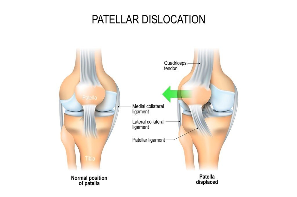 Best Patella dislocation treatment in Gurugram Sector 51