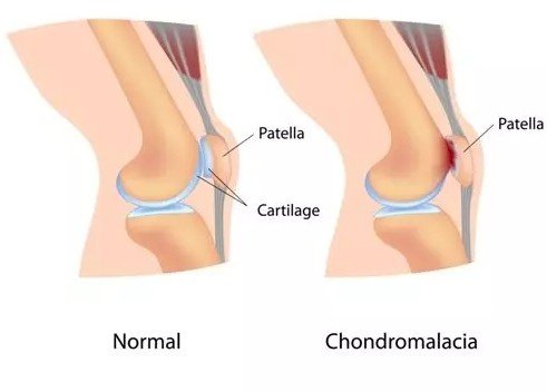 Best Chondromalacia Patella in Gurugram Sector 57