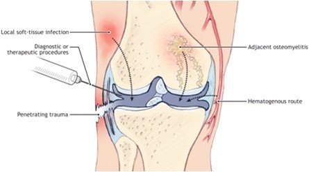 Best Septic Arthritis Treatment in Gurugram Sector 50