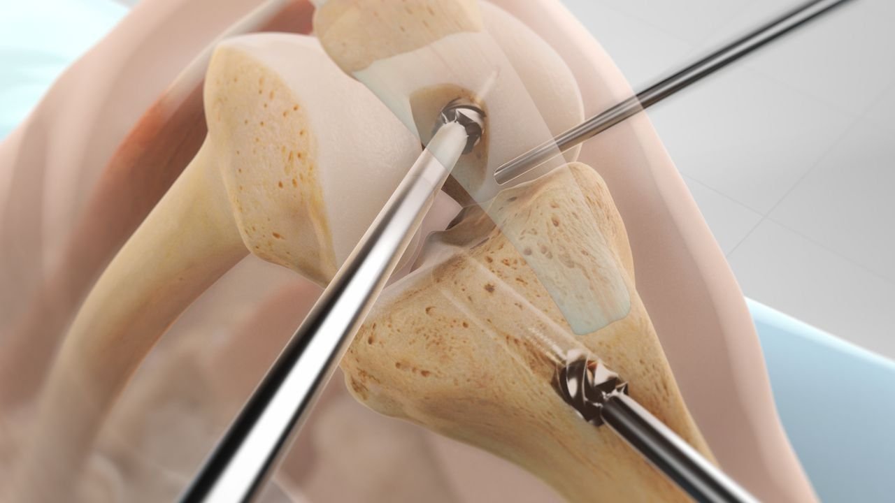 Best PCL Reconstruction in Udyog Vihar