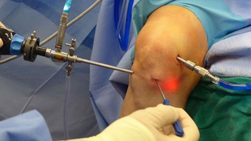 Best Arthroscopy Surgery in Gurugram