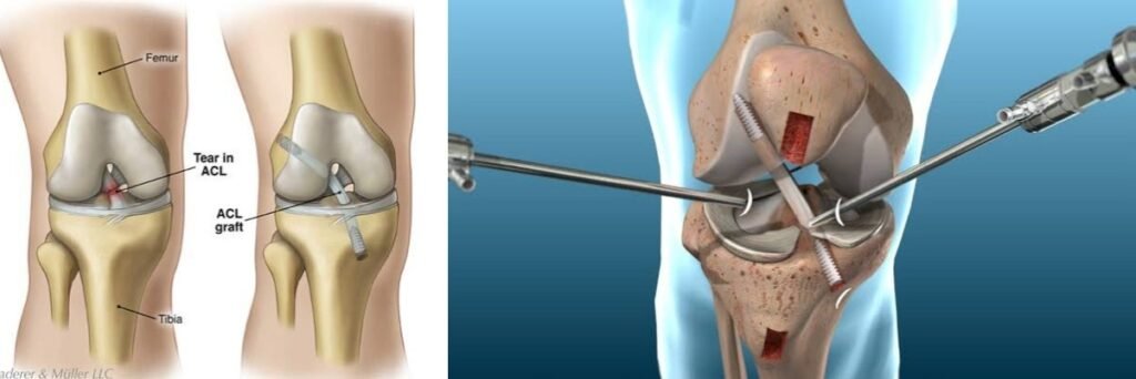 ACL Injury Treatment in Gurgaon