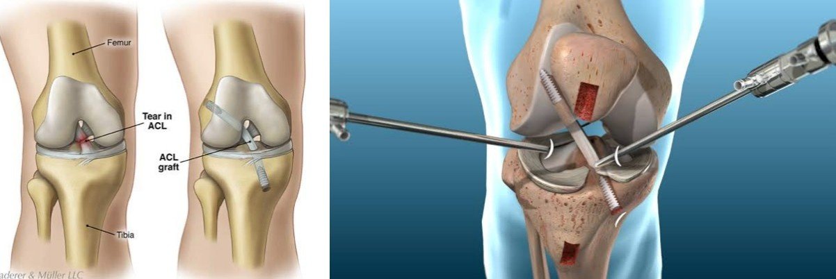 ACL Injury Treatment in Gurgaon