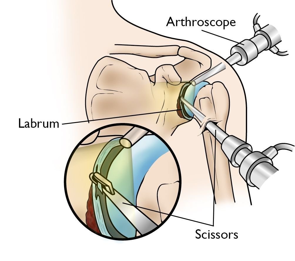 Best SLAP Tear Treatment in Gurgaon Sector 50