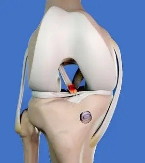 ACL Reconstruction Surgery in Gurugram
